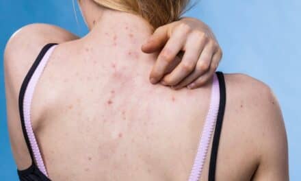 What Causes Back Acne?