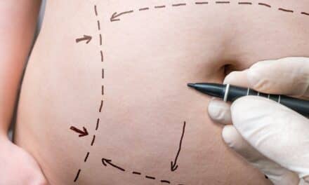 Study: Abdominoplasty Patients Find Pain Relief with Xaracoll Implant