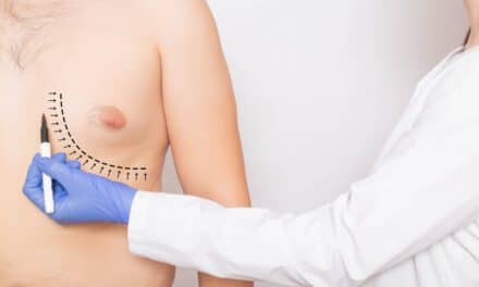 Gynecomastia Surgery Improves Quality of Life for Teens—Even with Complications