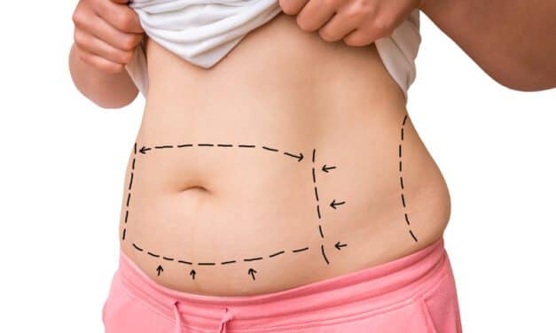 From Battlefield to OR, Abdominoplasty Still in Evolution
