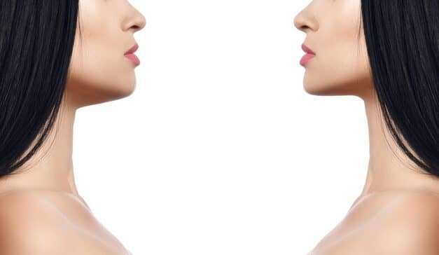 Influencing the Industry: Chin Liposuction Becoming Trend Among Young People