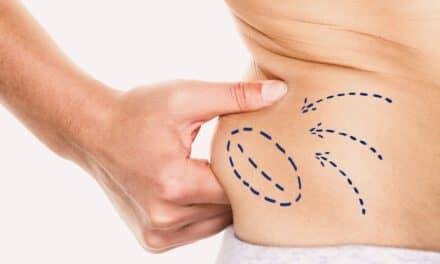 EON Laser Technology Offers Non-Invasive Fat Reduction