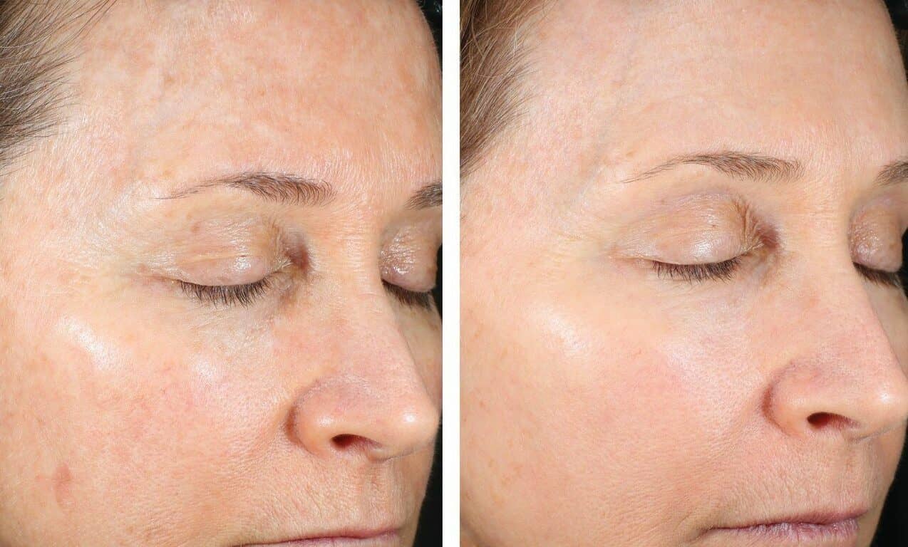FDA Clears Renuvion Dermal Headpiece for Wrinkle-Reduction Procedures 