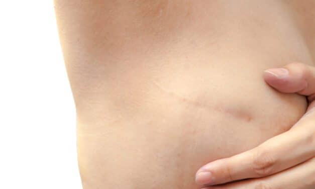 With ‘Batwing’ Mastopexy, More Women Can Undergo Nipple-Sparing Mastectomy