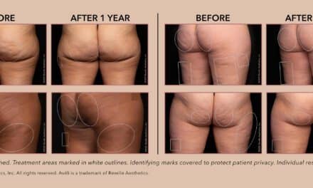 FDA Grants Avéli Extended Clearance for Cellulite Reduction  ￼