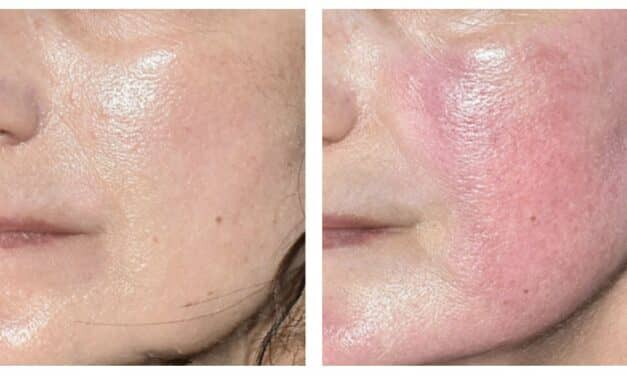 Beverly Hills Plastic Surgeon to Offer ADVATx Dermatology Laser