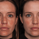 Unlocking Practice Growth: A Case Study on the Marini Peel System
