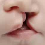 Cedars-Sinai Guerin Children’s Introduces Cleft and Craniofacial Program