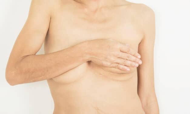 Frontiers  Breast Reconstruction after Mastectomy