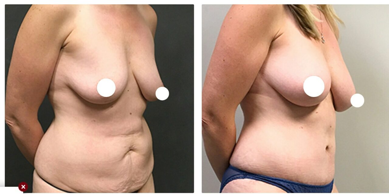 Surgeon Touts Breast Fat Transfer Technique