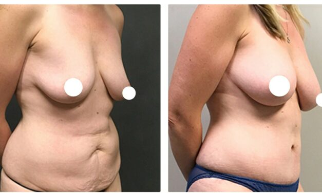 Surgeon Touts Breast Fat Transfer Technique