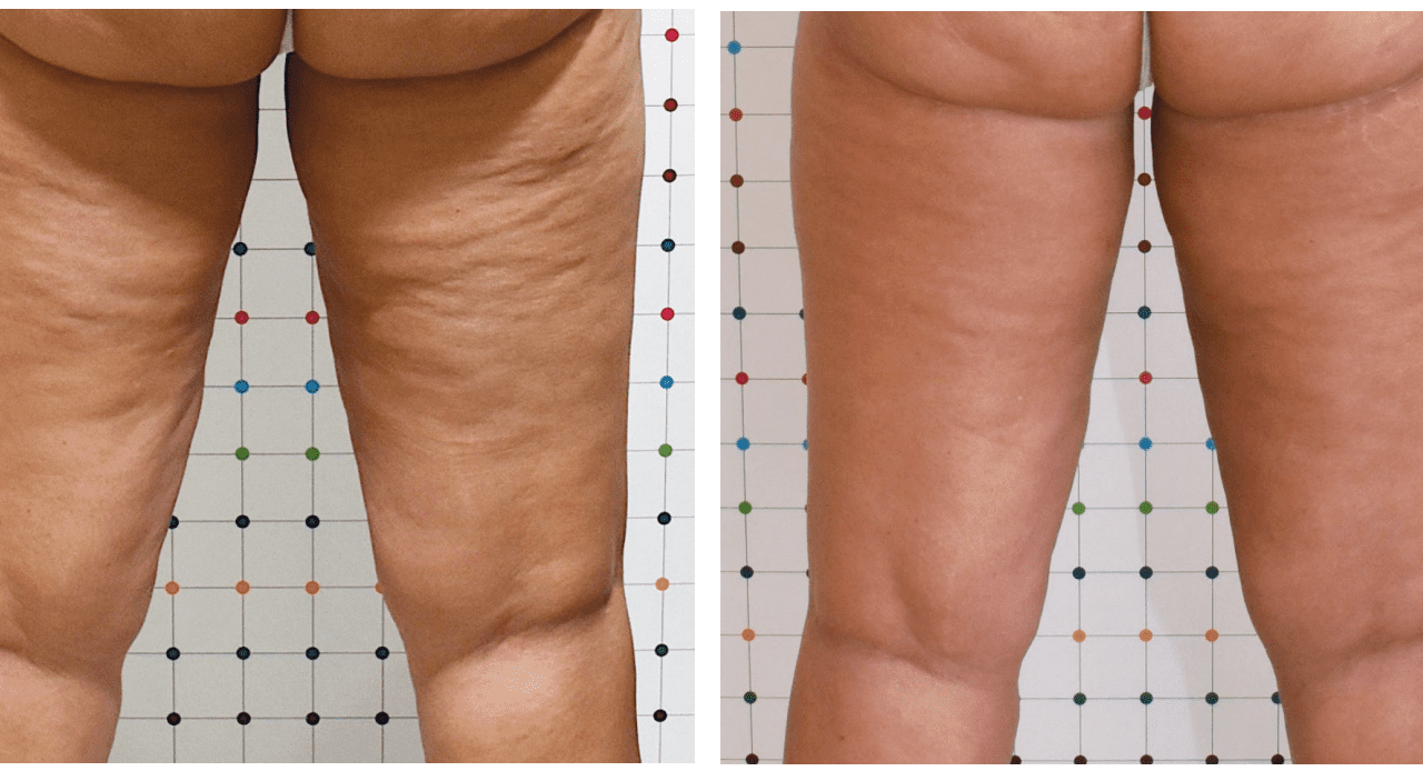 Sentient Launches Cellulite Reduction Device in U.S.