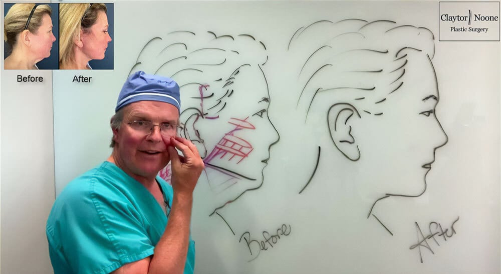 Deep Plane Facelift Video Goes Viral 