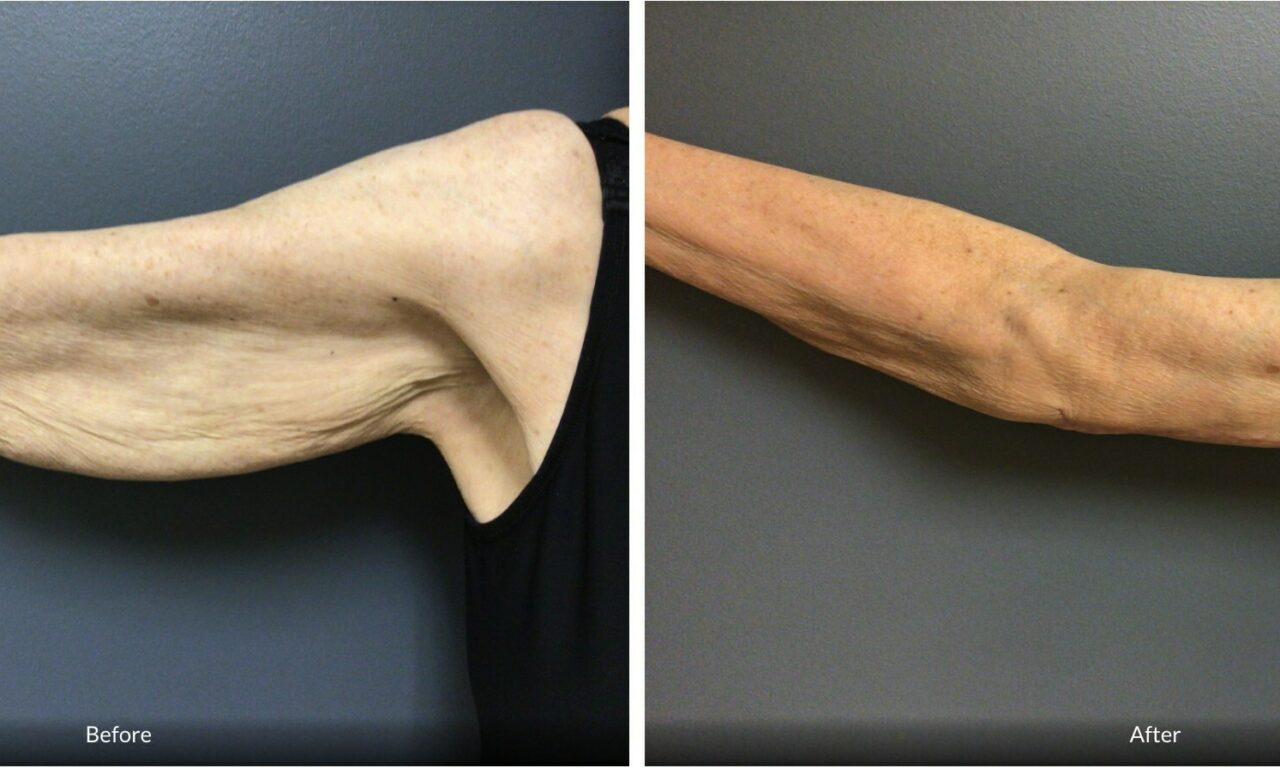 Aesthetic Center Sees Surge in Arm Lifts After Weight Loss