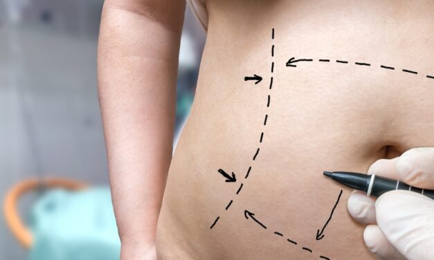 Bariatric Surgery Patients Regain More Weight After Body Contouring