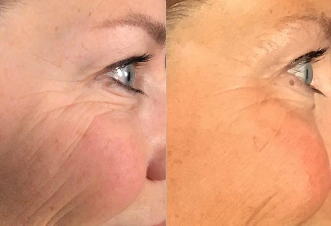 Cynosure, LaserAway Advance RF Microneedling Technology