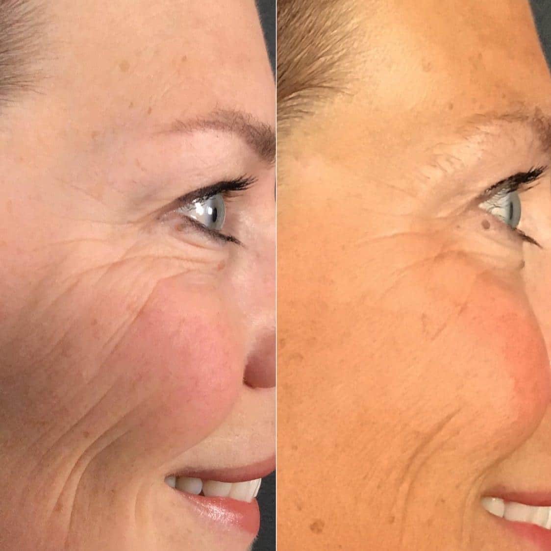 Cynosure, LaserAway Advance RF Microneedling Technology Plastic