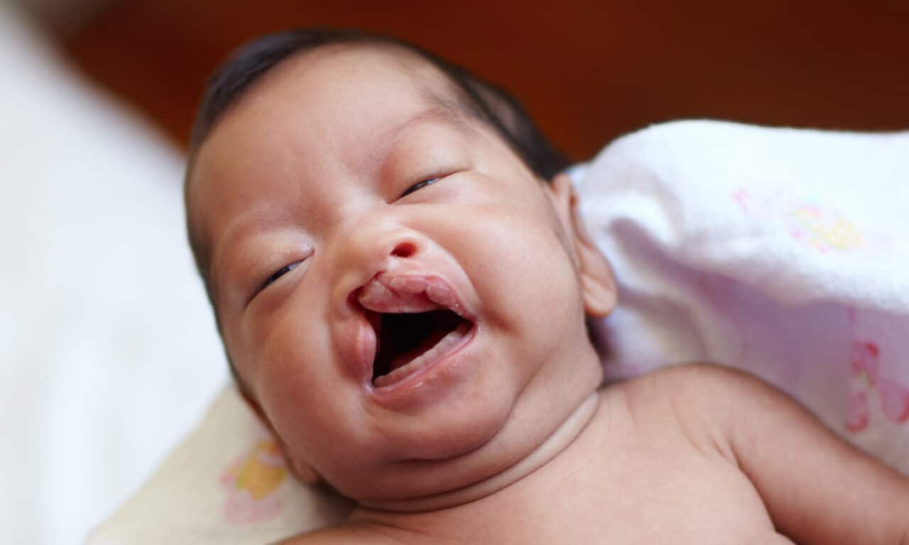 Racial and Ethnic Disparities in Cleft Lip Surgery for Children