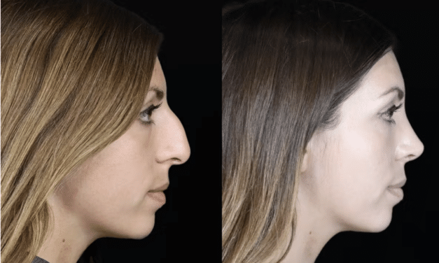 Nerve Block Innovation: Reducing Pain in Rhinoplasty