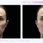 Non-Invasive Facial Lifting Procedure Emface Surpasses 1 Million Treatments 
