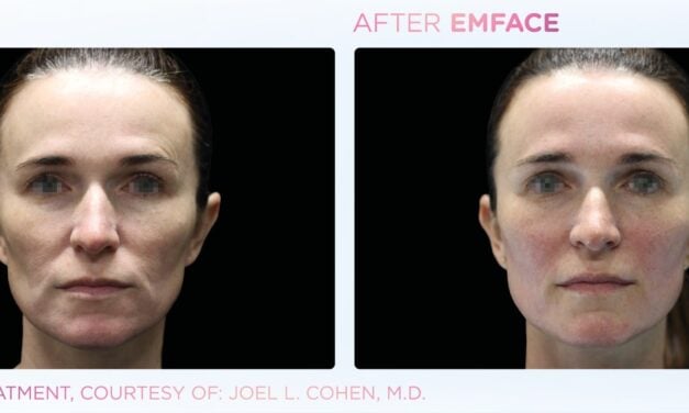 Non-Invasive Facial Lifting Procedure Emface Surpasses 1 Million Treatments 