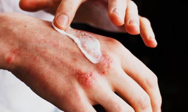 Investigational Cream Improves Chronic Hand Eczema Symptoms