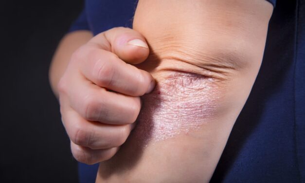 TYK2 Inhibitor Shows Promise for Moderate-to-Severe Psoriasis