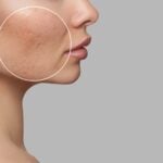Next-Gen Fraxel Laser Launches with Upgraded Design and Treatment Efficiency
