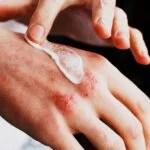 Long-Term Study Suggests Extended Relief from Atopic Dermatitis After Topical Treatment