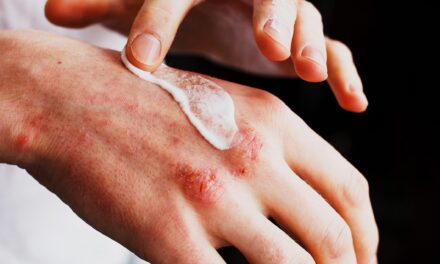Long-Term Study Suggests Extended Relief from Atopic Dermatitis After Topical Treatment