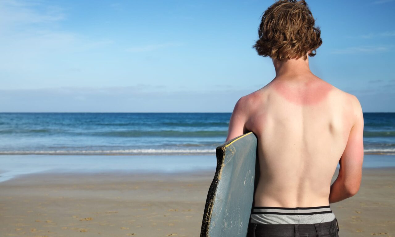 Survey Shows More Americans Are Getting Sunburned