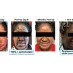 RECELL Brings New Options to Acute Wound Care and Scar Revision