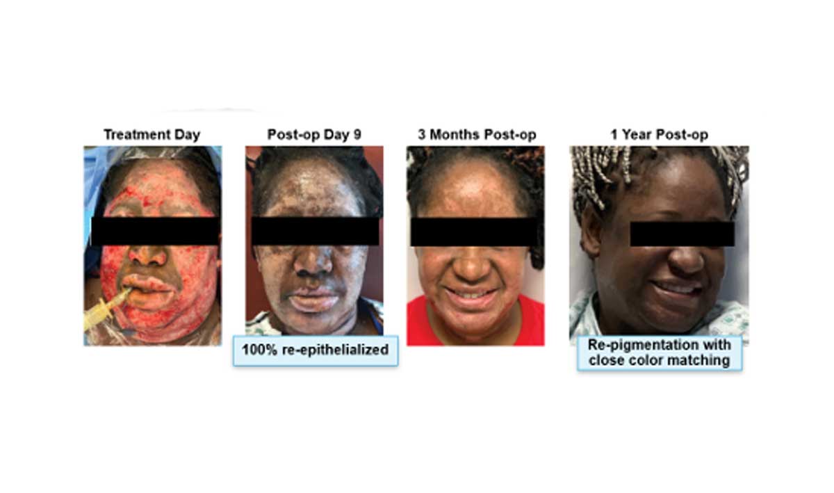 RECELL Brings New Options to Acute Wound Care and Scar Revision