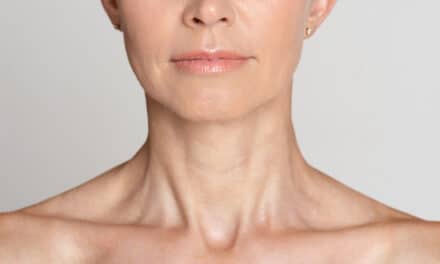 Health Canada Approves Radiesse for Décolleté Wrinkles