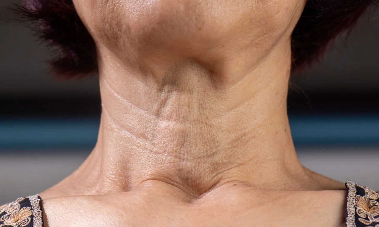 Skinvive by Juvéderm Targets Neck Lines in New FDA Filing