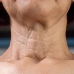 Skinvive by Juvéderm Targets Neck Lines in New FDA Filing