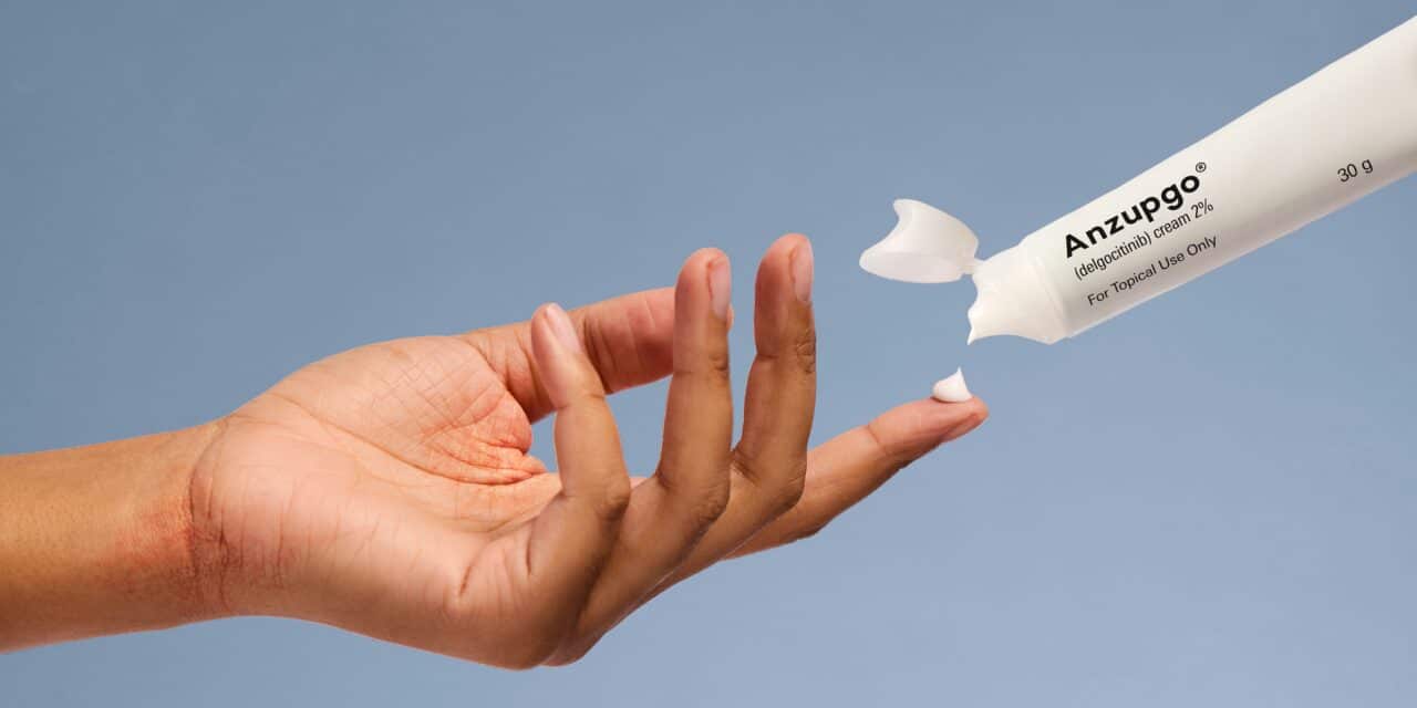 FDA Approves Treatment for Moderate-to-Severe Chronic Hand Eczema