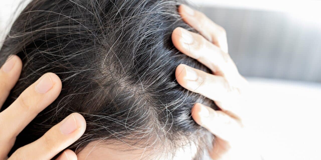 Phase 3 Trial Finds Upadacitinib Promotes Significant Hair Regrowth in Alopecia Areata