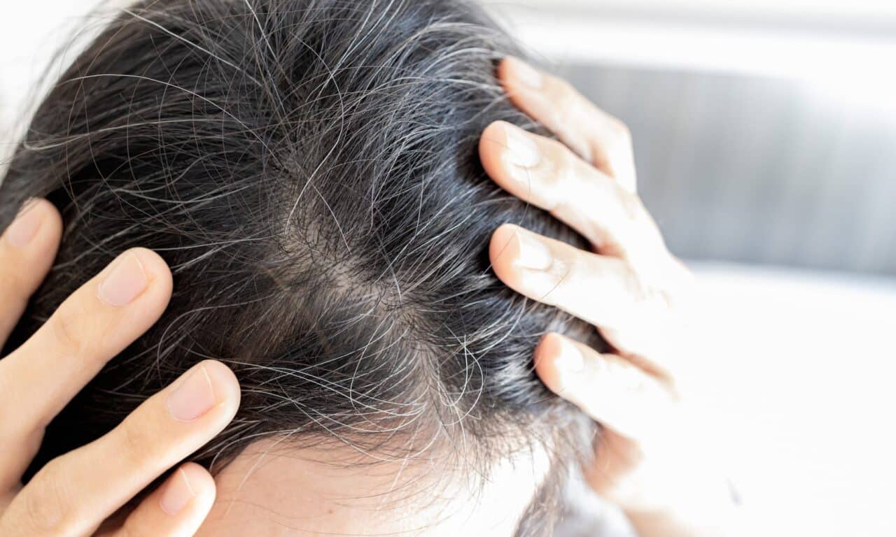 Phase 3 Trial Finds Upadacitinib Promotes Significant Hair Regrowth in Alopecia Areata