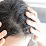 Phase 3 Trial Finds Upadacitinib Promotes Significant Hair Regrowth in Alopecia Areata