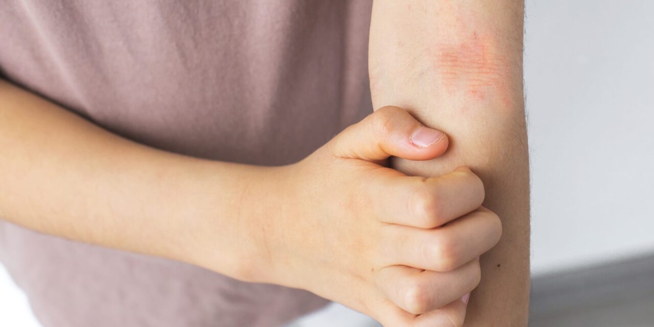 FDA Extends Review of Opzelura for Pediatric Atopic Dermatitis