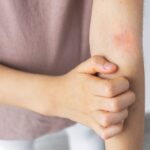 FDA Extends Review of Opzelura for Pediatric Atopic Dermatitis