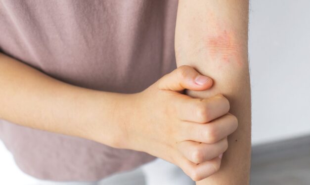 FDA Extends Review of Opzelura for Pediatric Atopic Dermatitis