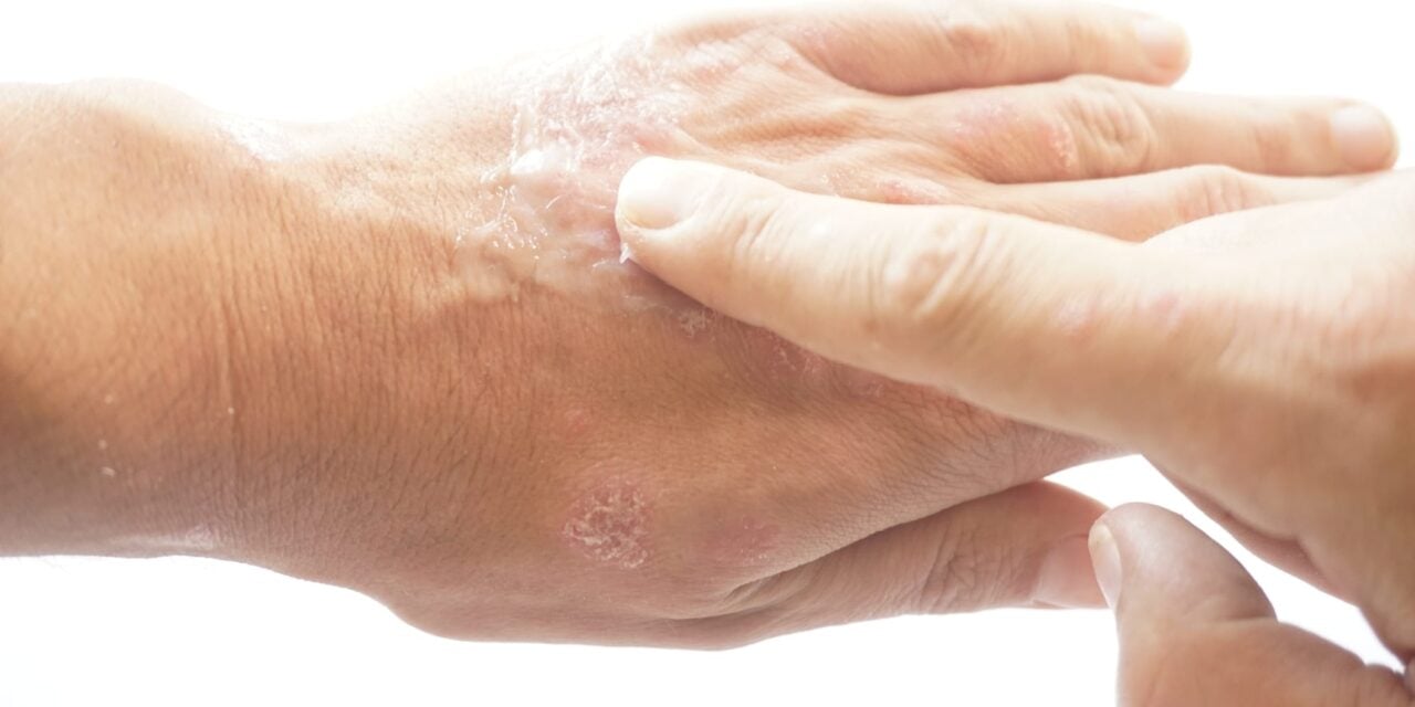 AAD Issues Strong Recommendations for Four Therapies in Updated Atopic Dermatitis Guidelines