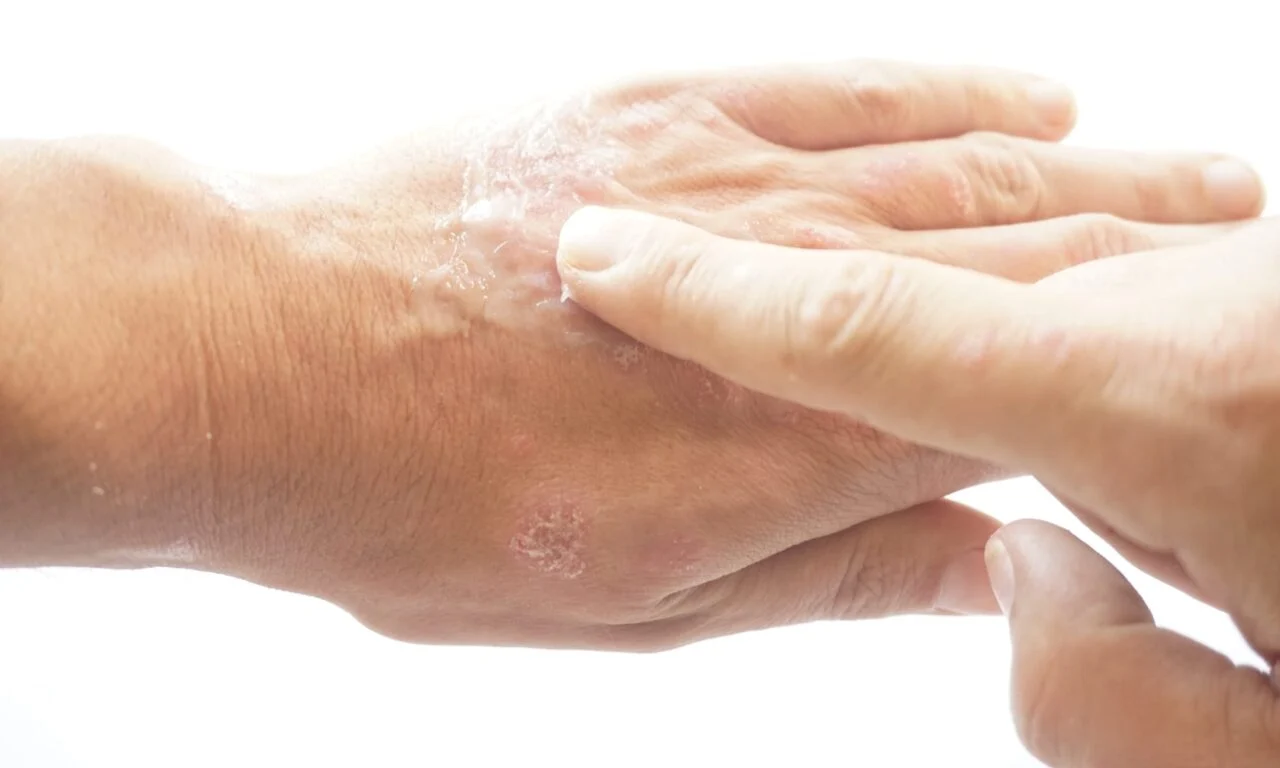 AAD Issues Strong Recommendations for Four Therapies in Updated Atopic Dermatitis Guidelines