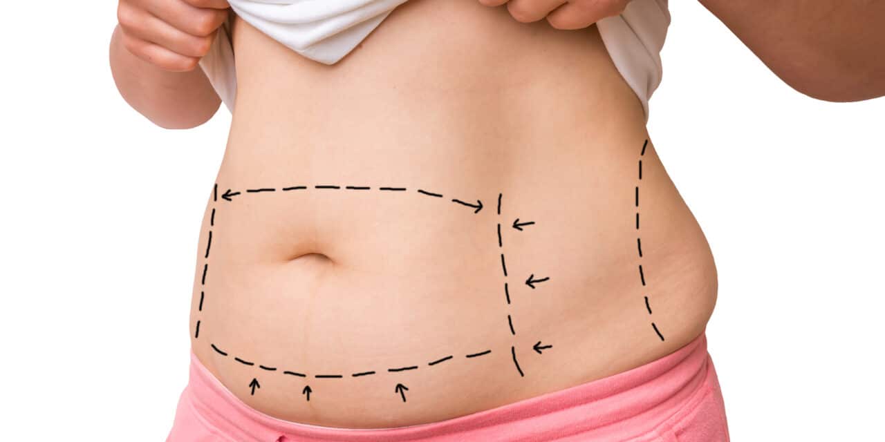 Supporting the Post-Weight Loss Patient: Financing, Follow-Up, and Comprehensive Care
