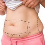 Supporting the Post-Weight Loss Patient: Financing, Follow-Up, and Comprehensive Care