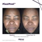 Gentler PixelPeel Laser Peel Introduced for Alma Systems
