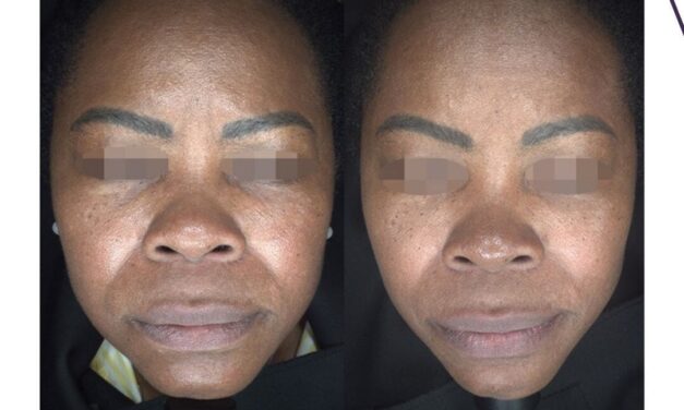 Gentler PixelPeel Laser Peel Introduced for Alma Systems