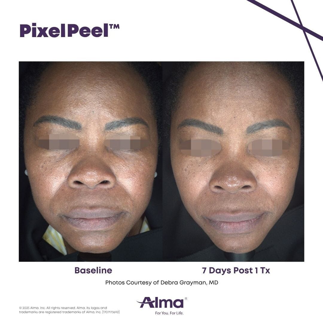 gentler-pixelpeel-laser-peel-introduced-for-alma-systems-plastic